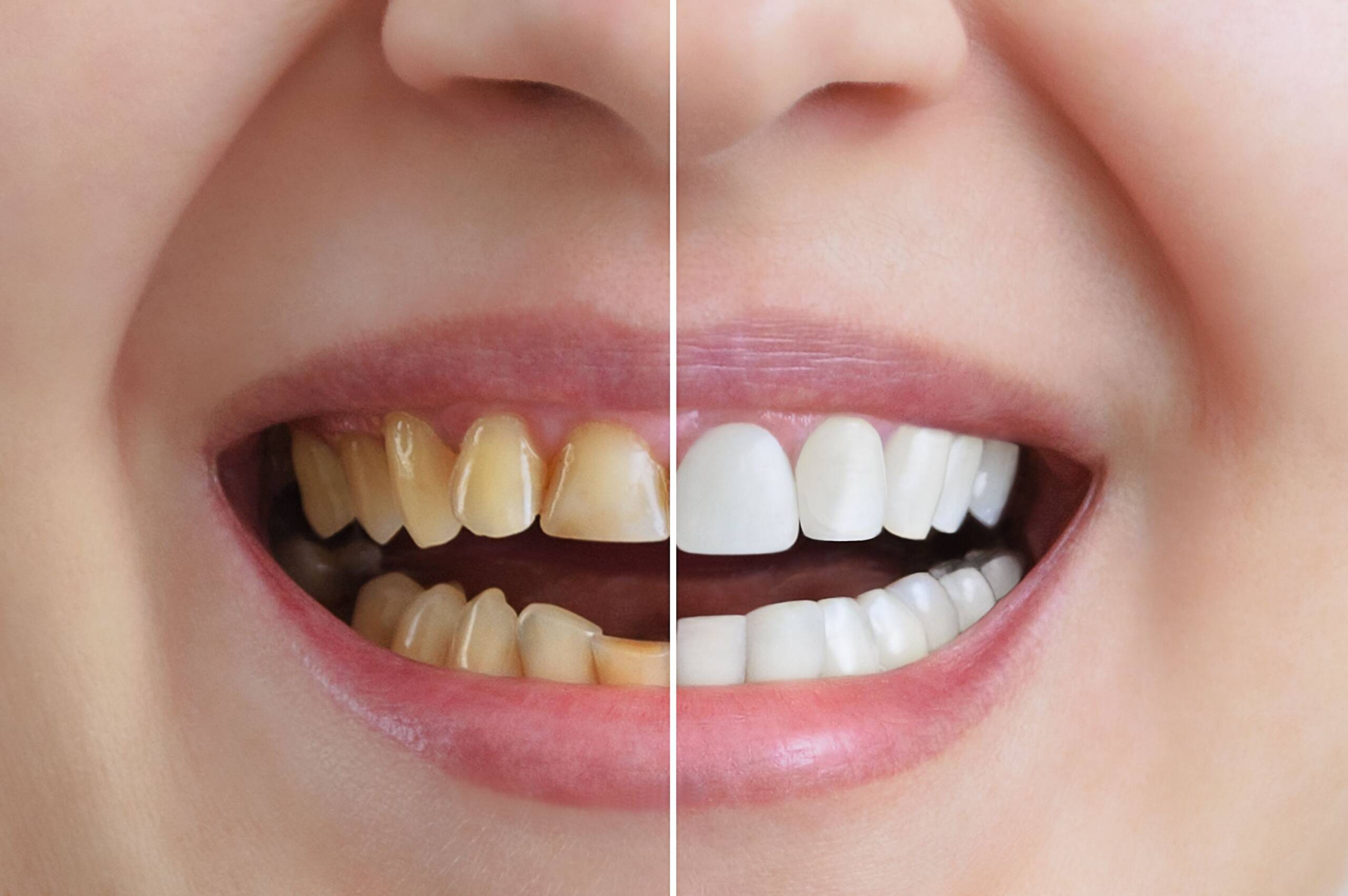 How To Avoid Teeth Stains